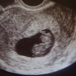 Previniendo el Virus sincitial respiratorio (VSR)