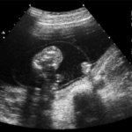 Aprende sobre el ABC del virus sincicial respiratorio (VSR)