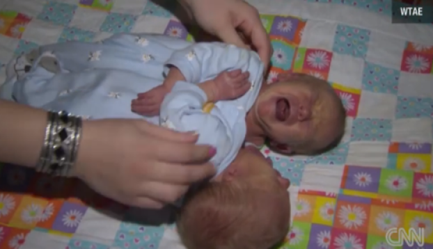 gemelos siameses inoperables