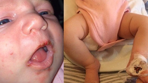 contrae herpes por beso en la boca